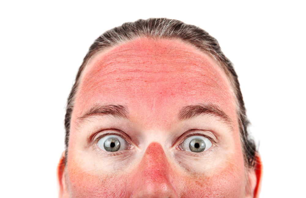 日焼け後のケア！顔や赤い鼻のケアを急いでやるべき理由